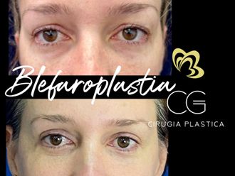 Blefaroplastia antes y después - 875541