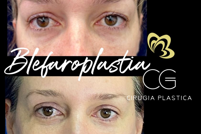 Blefaroplastia antes y después - 875541