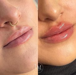 Aumento de labios - Dra. Laura Mosquera