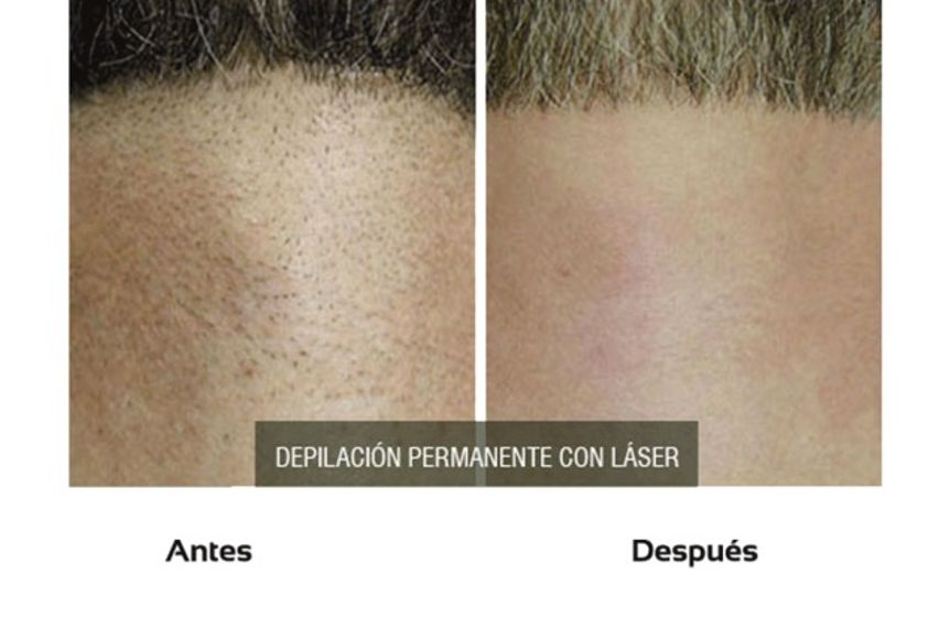 Depilación Láser antes y después - 510404