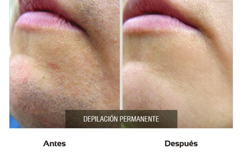 Depilación Láser antes y después - 510405