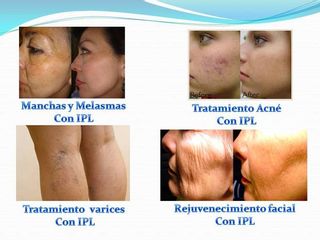 Manchas Acné Varices Rejuvenecimiento Facial