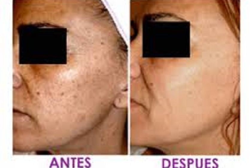 Manchas en la piel antes y después - 603640