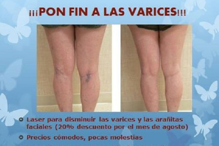 Várices antes y después - 606846