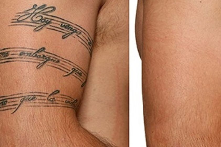 Borrar tatuajes antes y después - 606848
