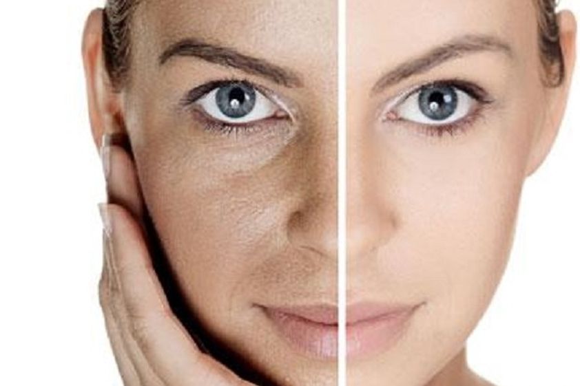 Plasma rico en plaquetas antes y después - 606849