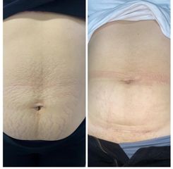 Corrección de Estrias - Prhomex Exthetic - Dr. Oscar Calle Londoño.