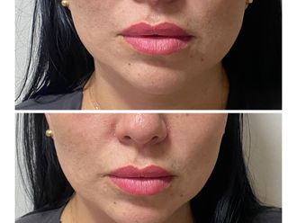 Aumento de labios antes y después - 879143