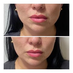 Aumento de Labios - Prhomex Exthetic - Dr. Oscar Calle Londoño.