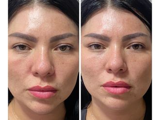 Aumento de labios antes y después - 879144