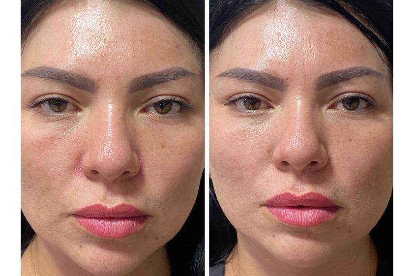 Aumento de labios antes y después - 879144