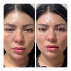 Aumento de Labios - Prhomex Exthetic - Dr. Oscar Calle Londoño.