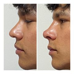 Rinomodelación - Prhomex Exthetic - Dr. Oscar Calle Londoño.