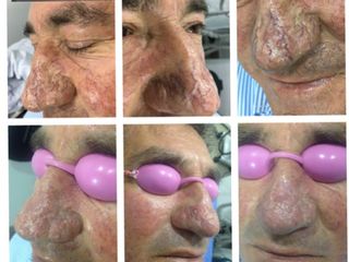 Tratamiento de rinofimia.