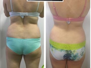Moldeamiento corporal con contourshape!