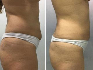 Lipo corporal no quirúrgico! 