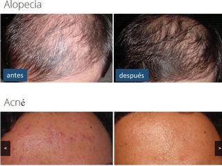 Alopecia y acne