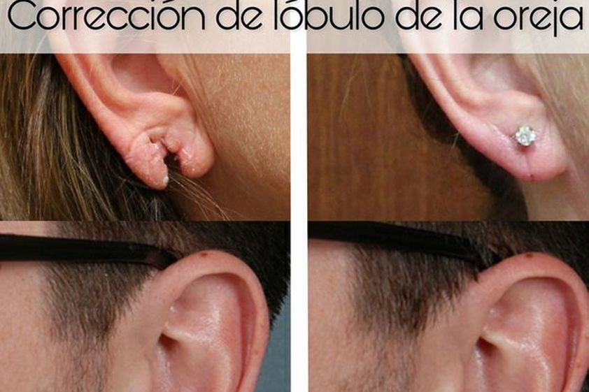 Cirugía reconstructiva antes y después - 606938