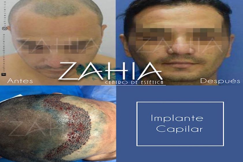 Implantes de cabello antes y después - 640225