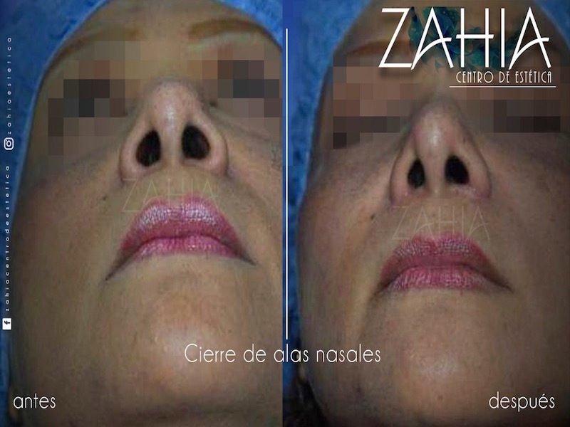 Rinofast antes y despues de adelgazar