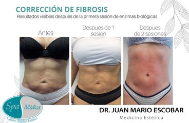 Celulitis - Dr. Juan Mario Escobar