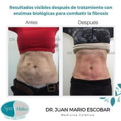 Tratamiento enzimas biológicas - Dr. Juan Mario Escobar