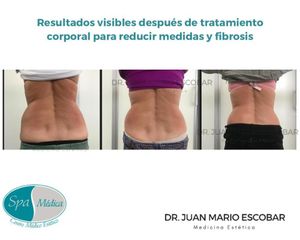 Celulitis - Dr. Juan Mario Escobar