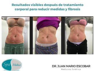 Celulitis antes y después - 825469