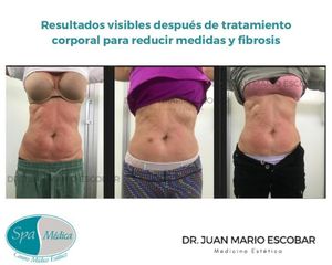 Celulitis - Dr. Juan Mario Escobar