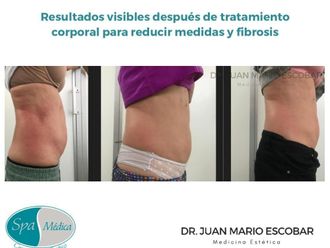 Celulitis antes y después - 825470