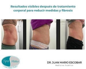 Celulitis - Dr. Juan Mario Escobar