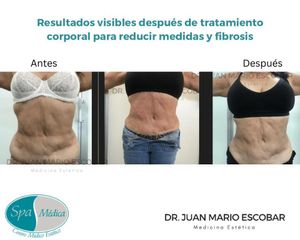 Tratamientos para adelgazar - Dr. Juan Mario Escobar