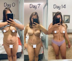 Lipoescultura - Dr. Carlos Zuleta Bechara