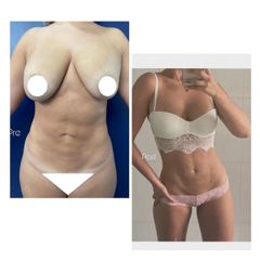 Lipoescultura - Dr. Carlos Zuleta Bechara