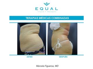 Liposucción