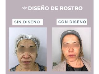 Rejuvenecimiento facial