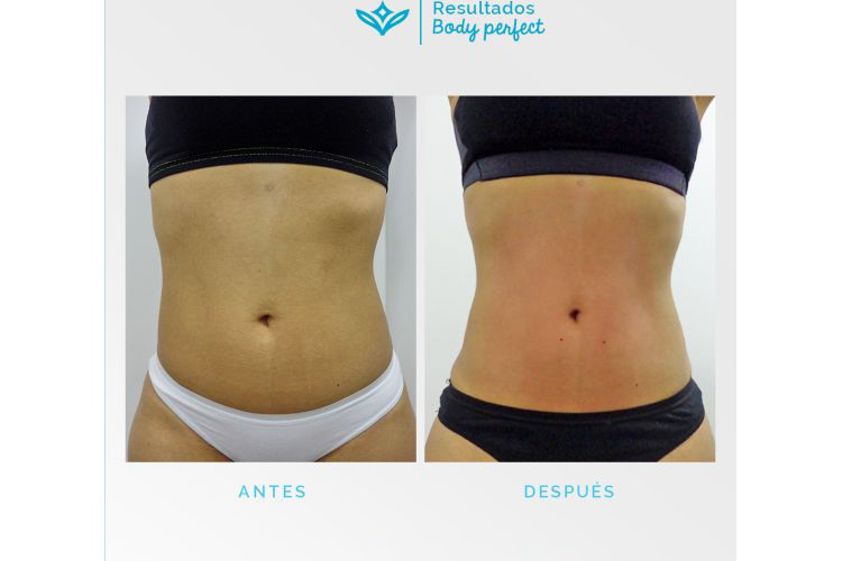 Carboxiterapia antes y después - 648187