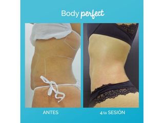 Carboxiterapia
