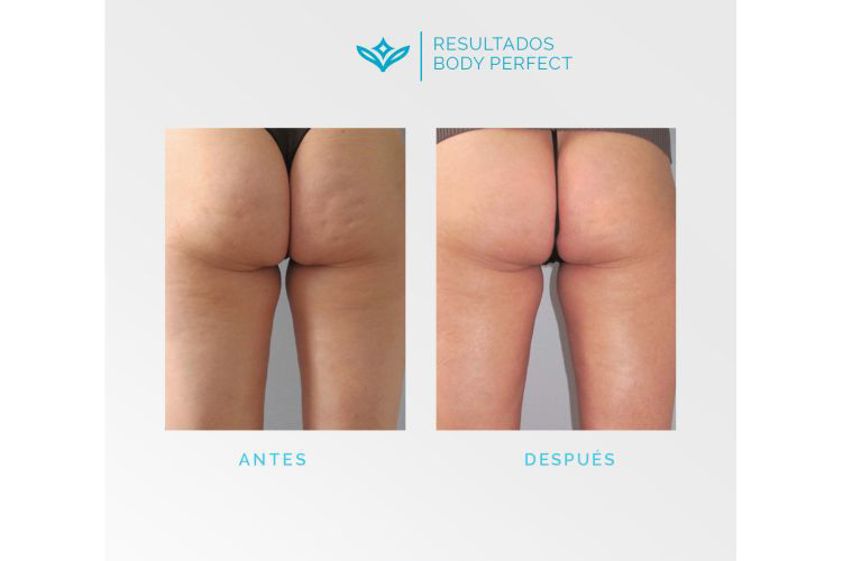 Celulitis antes y después - 648303