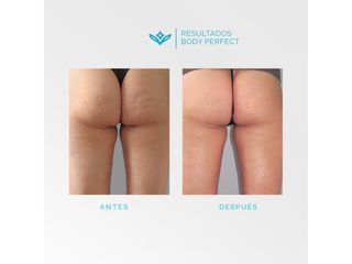 Celulitis