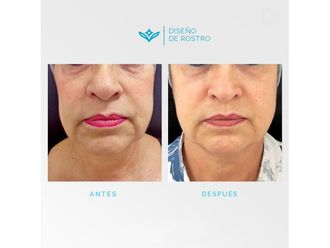 Rejuvenecimiento facial - 648307