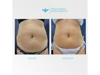 Carboxiterapia antes y después - 648310