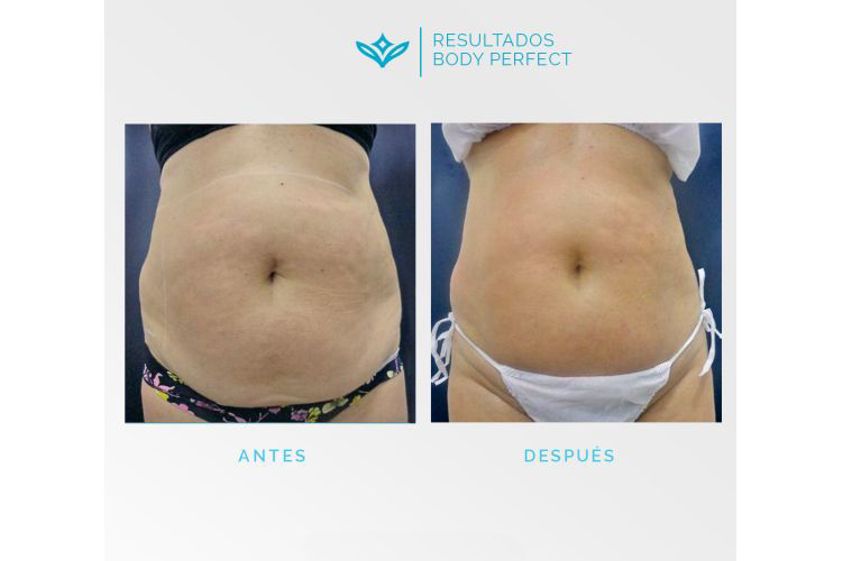 Carboxiterapia antes y después - 648310