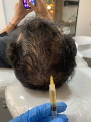 Mesoterapia capilar