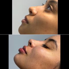 Rinomodelacion y Perfilamiento labios con ácido hialuronico - Dra. Tatiana zea