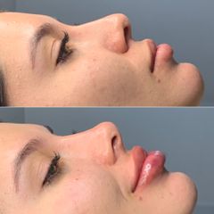 Rinomodelacion, relleno de fosa piriforme y aumento de labios - Dra. Tatiana zea