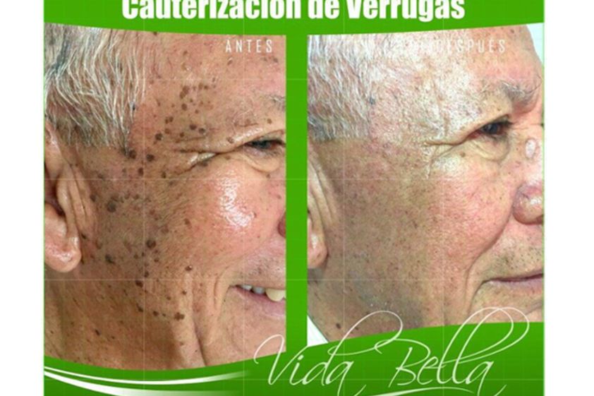 Verrugas antes y después - 639803