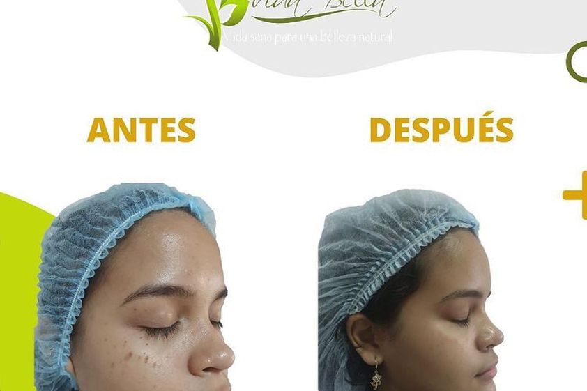 Lunares antes y después - 807867