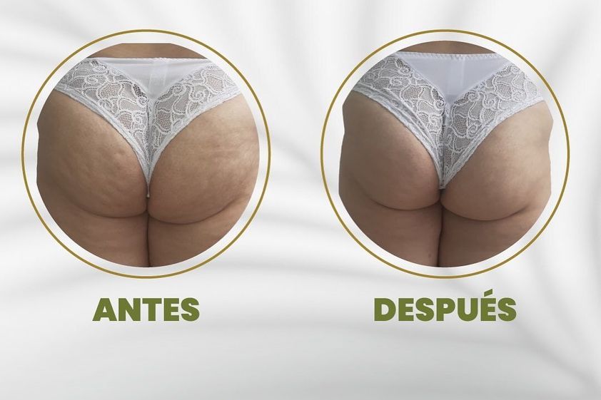 Celulitis antes y después - 827568