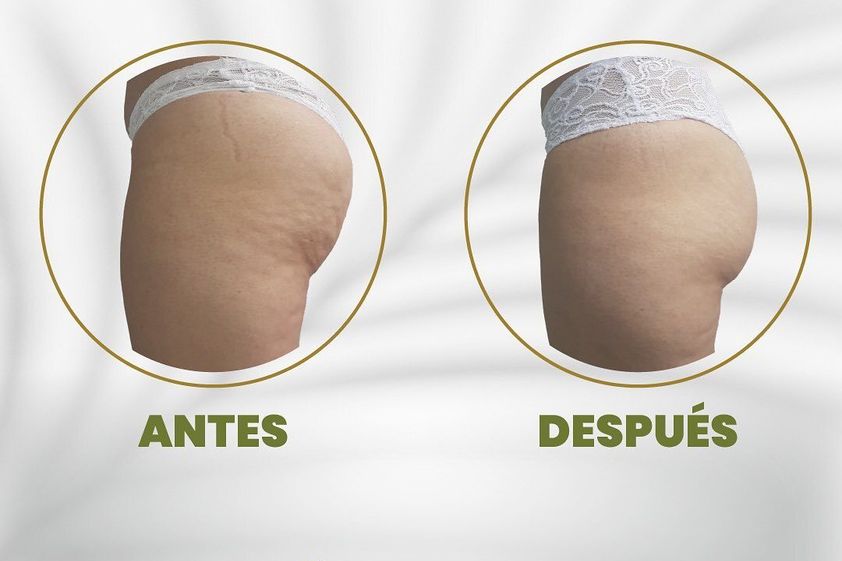 Celulitis antes y después - 827569